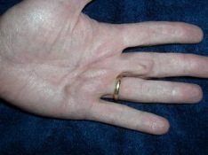 Dupuytren Contracture Mild